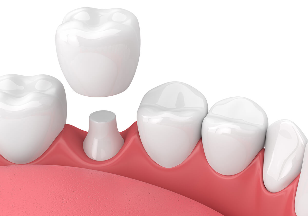 Dental Crowns Treatment in Charlottesville Area