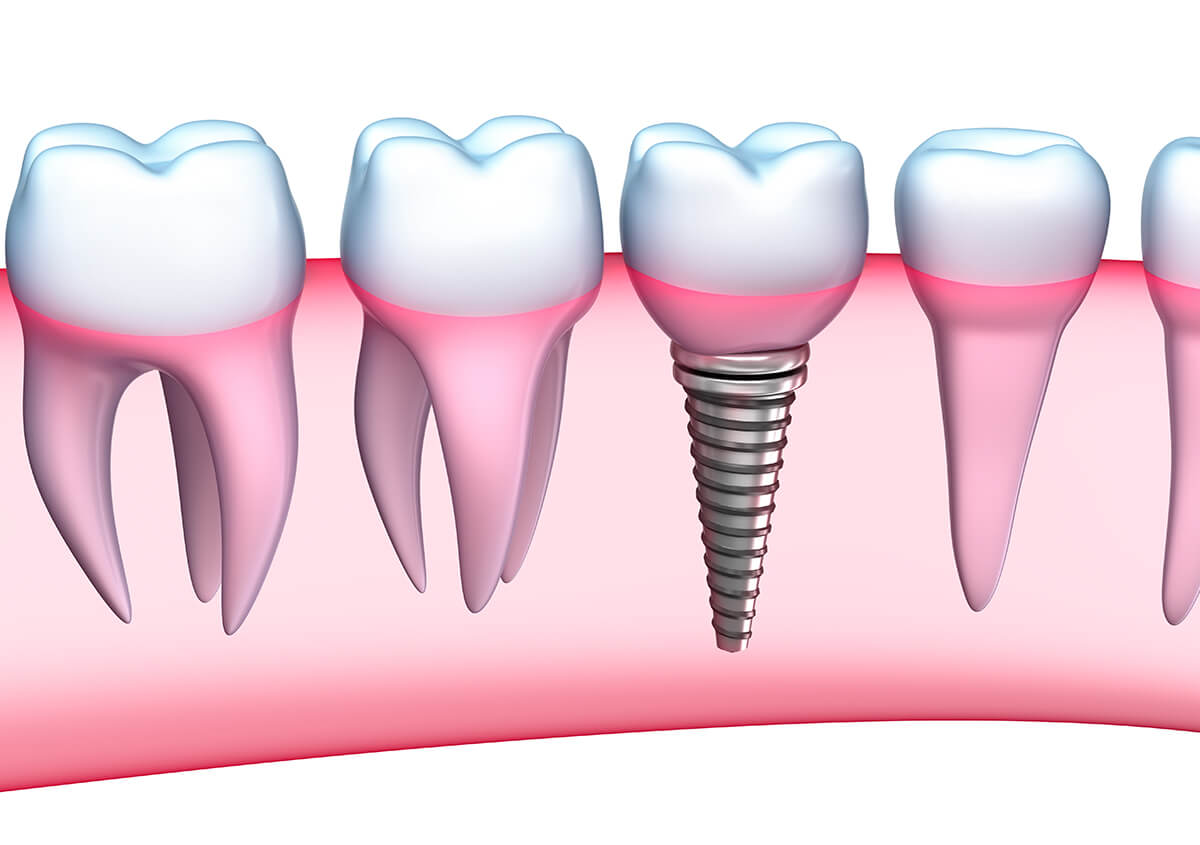 Missing Teeth Implants Dentist in Charlottesville Area