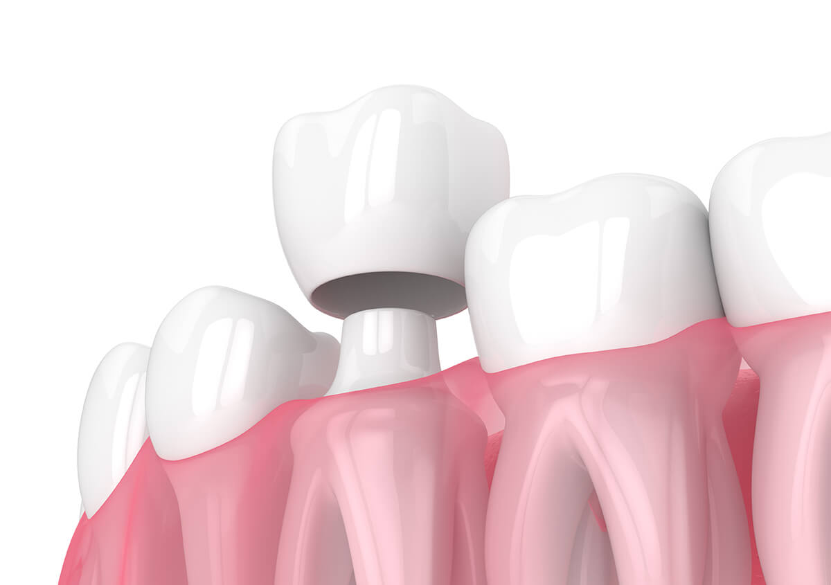 Dental Crowns for Teeth in Charlottesville Area