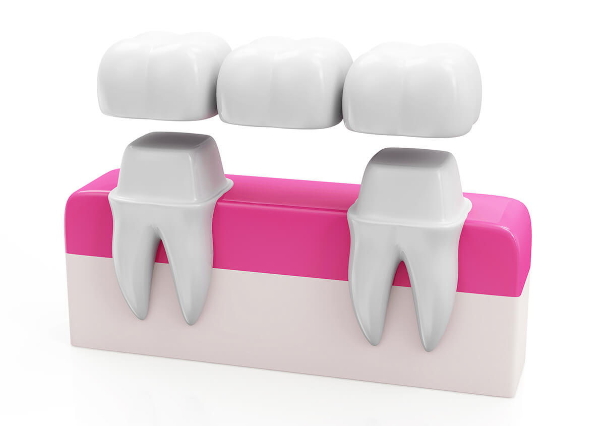 Dental Bridge Front Teeth in Charlottesville VA Area