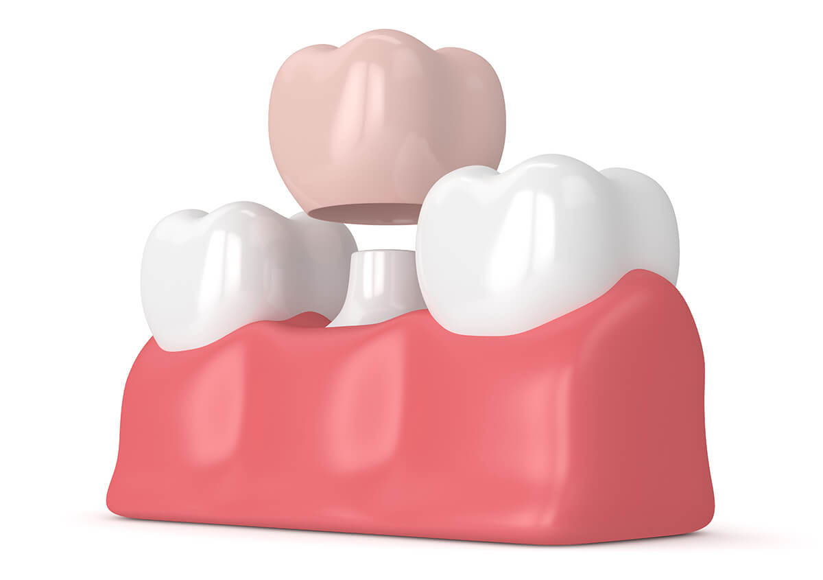 Dental Crowns Service in Charlottesville Area