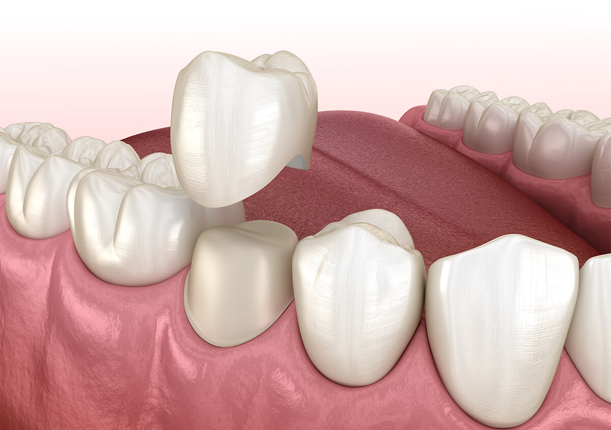 Dental Crowns Treatment in Charlottesville VA Area